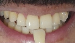 Antes
